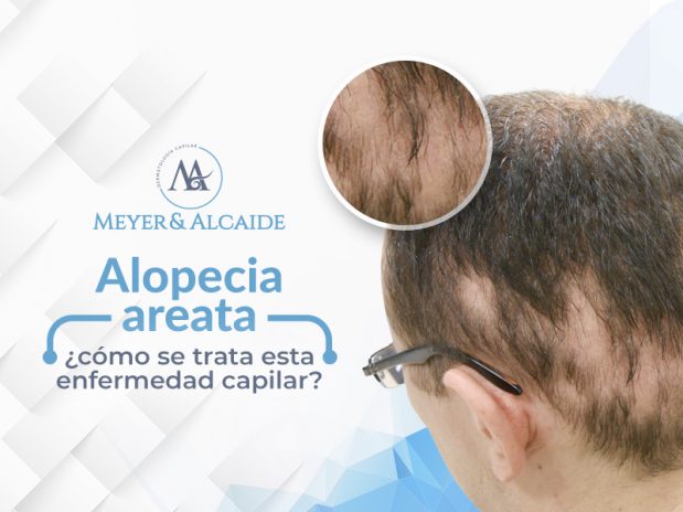 ¿Qué es la Alopecia Areata? Descubre más sobre esta patología