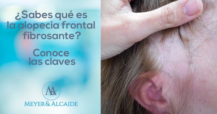 ¿Sabes qué es la alopecia frontal fibrosante? Conoce las claves