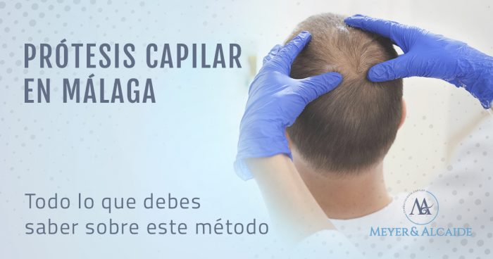 Prótesis capilar en Málaga: todo lo que debes saber sobre este método
