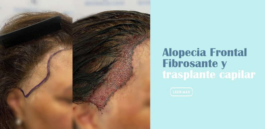 Alopecia Frontal Fibrosante y Trasplante Capilar