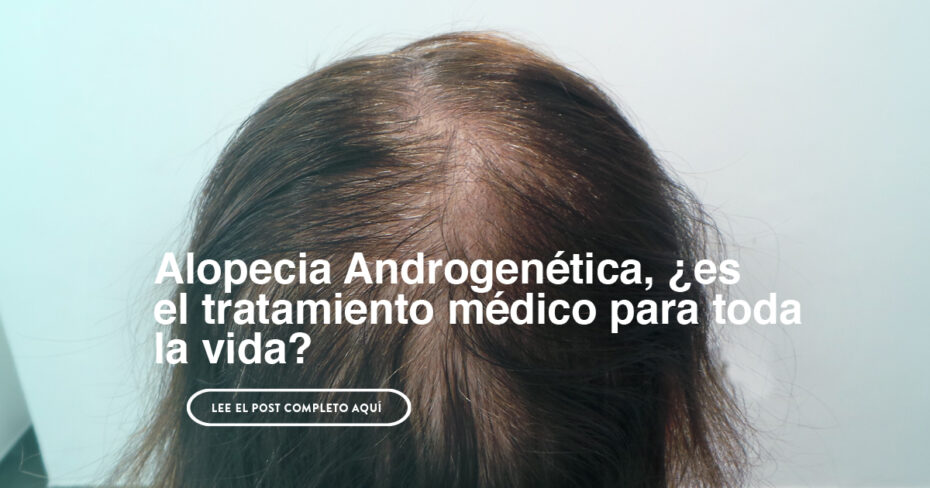 alopecia Androgenética y tratamiento, ¿es para toda la vida?
