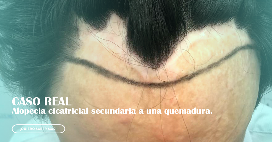 alopecia ccicatricial