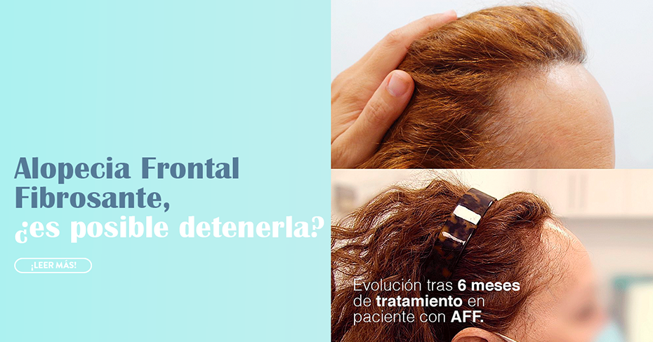 detención de la alopecia frontal fibrosante