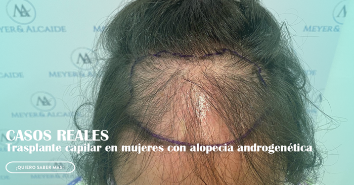 Trasplante capilar y Alopecia Androgenética en la mujer