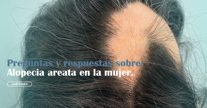 Alopecia Areata en mujeres