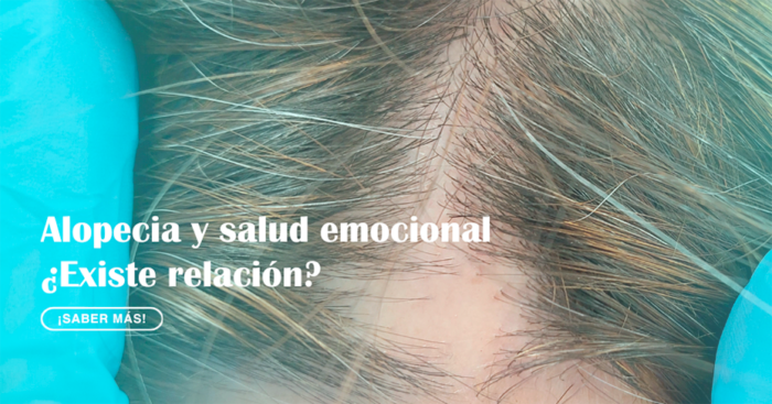 ¿Cómo afecta la alopecia en nuestra salud emocional?